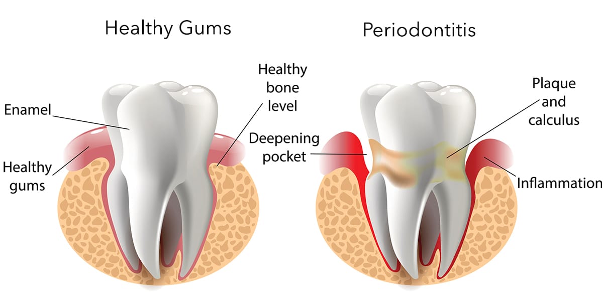 Healthy gums vs periodontitis graphic